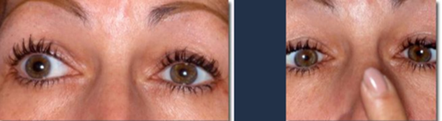 <p>anisocoria</p><p>blurred vision</p><p>brow ache from accom issue</p><p>photophobia</p><p>dark adaptation issues</p><p>Pulfrich stereo phenomenon</p>