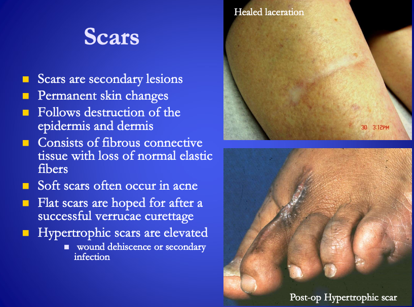 <p>Scars: changes in skin texture due to injury</p><ul><li><p><span><strong>[...]</strong></span> often occur in acne</p></li><li><p><span><strong>[...]</strong></span> hoped for after a success verrucae curettage</p></li><li><p><span><strong>[...]</strong></span> elevated&nbsp;</p></li></ul><p></p>