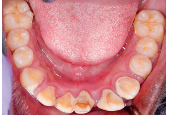 <p>8. Looking at Fig. 5.25, what gingiva is edematous?</p><p>a. Gingival margin</p><p>b. Attached gingiva</p><p>c. Interdental papilla</p><p>d. a. and c.</p>