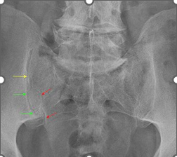 <p><span style="font-family: &quot;Wingdings 2&quot;;"></span><span><strong>Correct area </strong>of interest L5 superiorly. proximal 2/3 of sacrum inferiorly.</span></p><p style="text-align: left;"><span>&nbsp;&nbsp;Medial 1/3 of iliac bones laterally</span></p><p><span style="font-family: &quot;Wingdings 2&quot;;"></span><span><strong>Correct positioning </strong>to include</span></p><ul><li><p><span style="font-family: &quot;Wingdings 2&quot;;"></span><span>Sacrum co-incident with midline of image receptor.</span></p></li><li><p><span style="font-family: &quot;Wingdings 2&quot;;"></span><span>Superimposition of anterior posterior superior and inferior borders of sacrum.</span></p></li><li><p><span style="font-family: &quot;Wingdings 2&quot;;"></span><span>Sacral foramina equal in size and shape</span></p></li></ul><p></p>