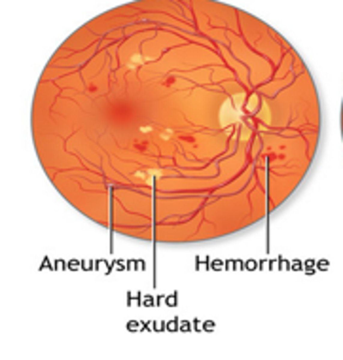 <p>Retinal hard exudates</p>