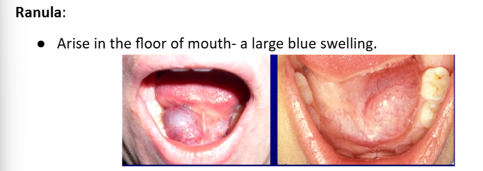<p>large blue painless swelling FOM usually in kids → may affect swallowing or airway concerns</p><p>usually extravasation cysts</p><p>from sublingual gland</p><p>2-3cm</p><p>rupture and recur</p>
