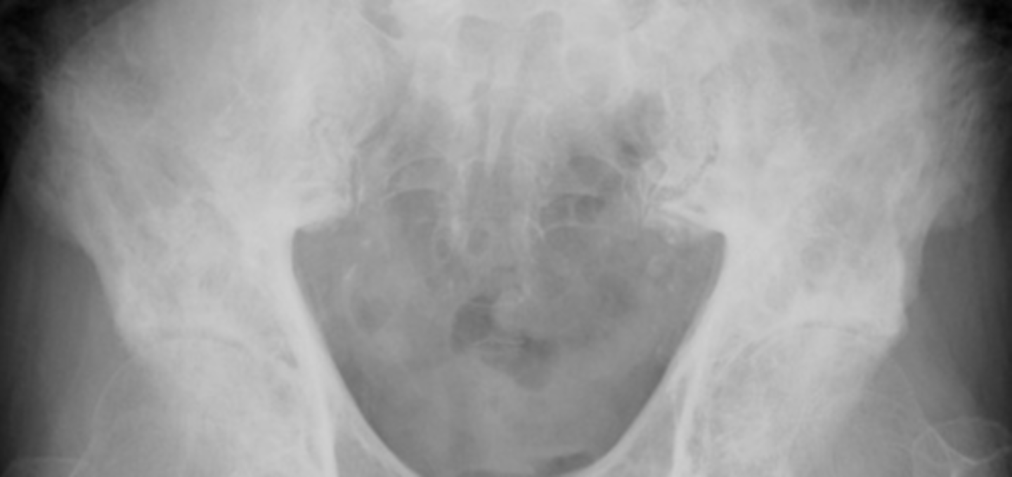 <p>what disease process is this showing</p>