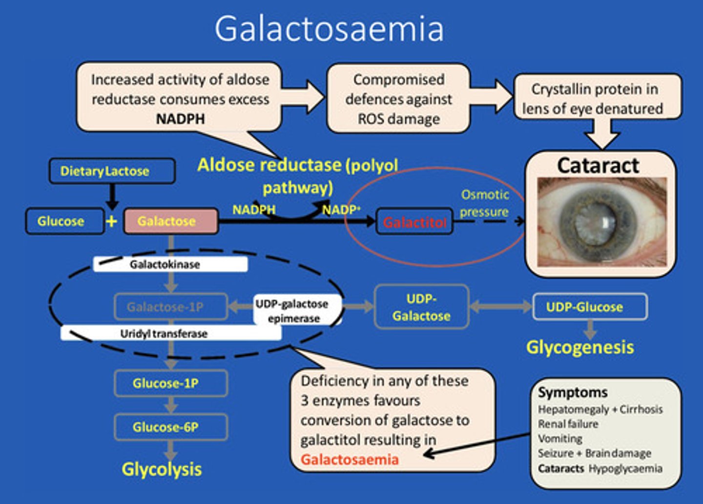 <p>Galactosaemia</p>
