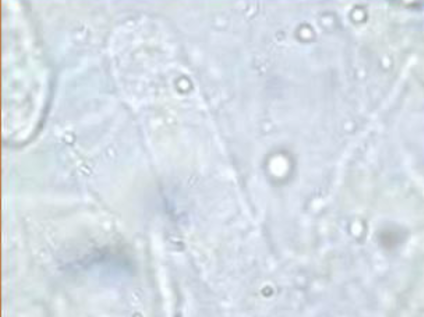 <p>What type of cast is this?</p><p>Why is it difficult to see?</p><p>What protein is it made of?</p><p>When it normal to see small numbers of this?</p><p>When is it normal to see high numbers of this?</p>