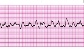 <p>What is this rhythm and how is it treated?</p>