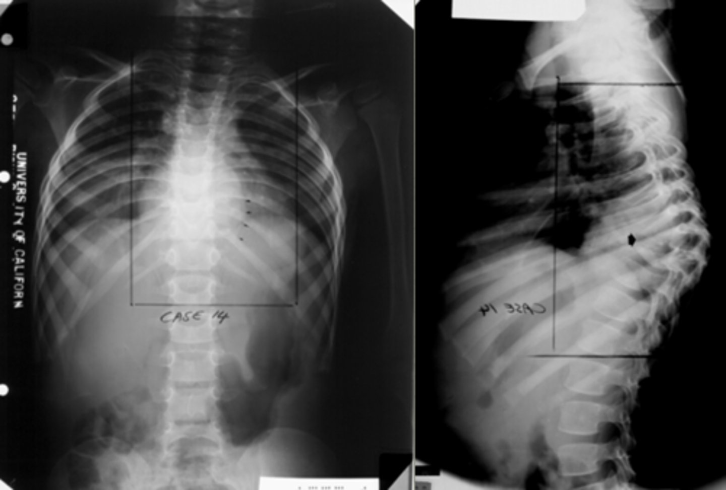 <p>Where the thoracic spine points outward like a camels back</p>