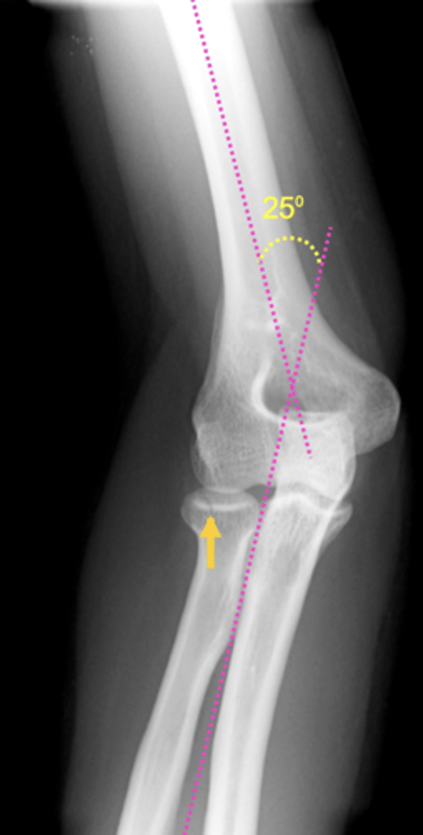 <p>Increased carrying angle (should be 15 degrees)</p>