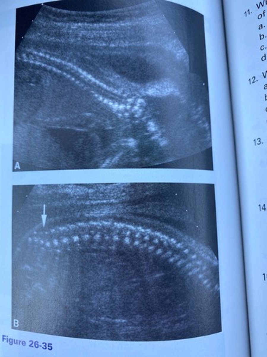 <p>What demonstration is Figure 26-35 of the spine?</p><p>a. Transverse</p><p>b. Coronal</p><p>c. Longitudinal</p><p>d. Three-dimensional</p>
