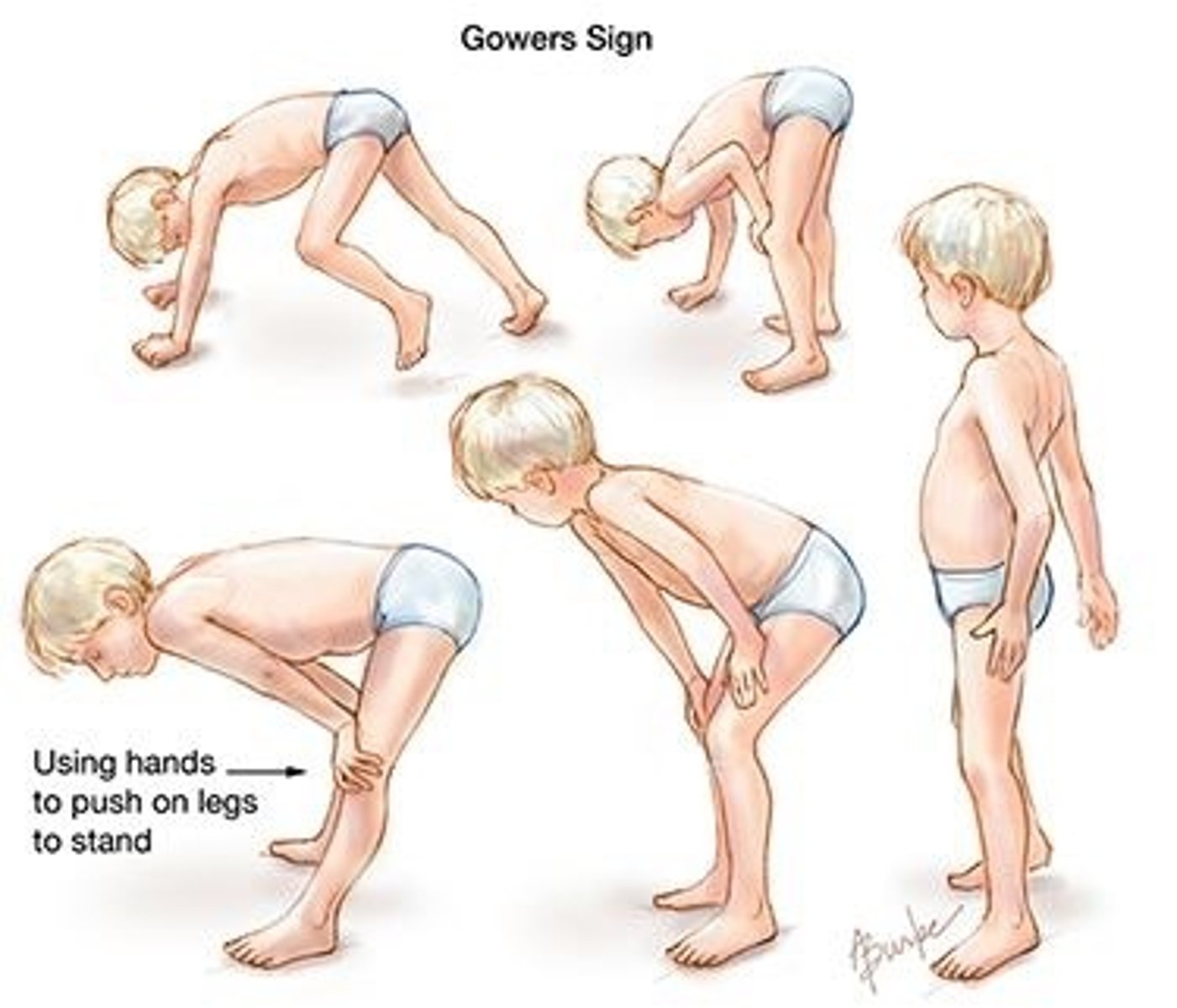 <p>child cannot rise from the floor in standard fashion because of increasing weakness</p><p>- sign of muscular dystrophy</p>