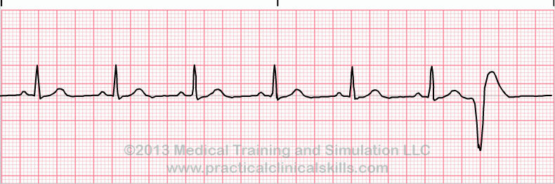 <p>what is this heart rhythm? </p>