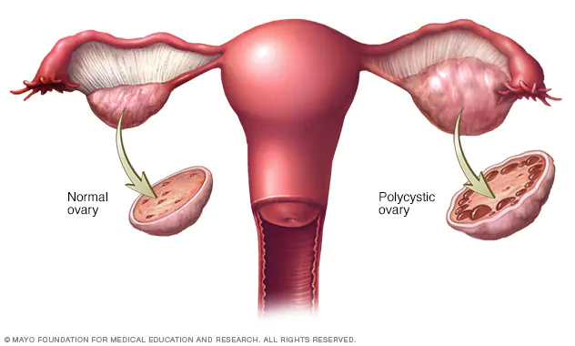 <ul><li><p>a hormonal condition causing enlarged ovaries with small cysts on the outer edges</p></li><li><p>symptoms include irregular menstruation, excess hair growth, obesity, and acne</p></li></ul>