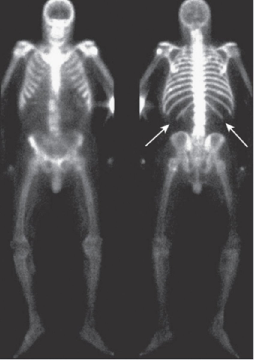 <p>metastatic disease involving nearly every bone in the axial skeleton</p>