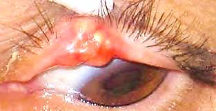 <p>Sebaceous carcinoma</p><p>N/E:</p><p>Localized or diffuse swelling of the tarsus.</p><p>M/P:</p><p>Tumor cells with sebaceous differentiation (cells with clear, foamy cytoplasm that resembles sebocytes).</p>