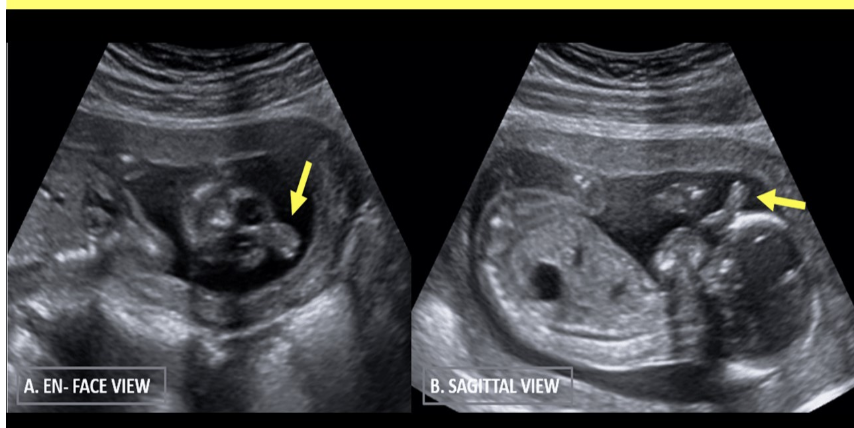 <p>which describes as an abn homogenous, soft tissue mass usually <strong>protruding</strong> from the <strong>anterior cranium</strong> or face w/assoc arhinia</p><p>a) teratoma</p><p>b) anostomia</p><p>c) proboscis</p><p>d) epidermal cyst</p>