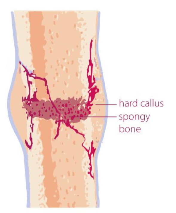 <p>the fibrocartilaginous callus is converted into a bony callus of spongy bone</p><p>it takes about two months for the broken bone ends to be firmly joined together after the fracture</p><p>similar to the endochondral formation of bone when cartilage becomes ossified;</p><p>osteoblasts, osteoclasts, and bone matrix are present</p><p>3-6 weeks</p>