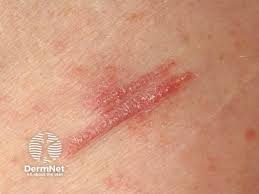 <p>PP: post-traumatic psoriatic phenomenon</p><p>E: trauma</p><p>CM: trauma to skin→plaque</p><p>TX:<br><u>topical:</u><br><strong>1st line→topical steroids</strong><br>topical calcipotriene<br>anthralin+coal tar<br>narrow band UV x 3x/week</p><p><u>systemic:</u><br>methotrexate<br>acute→cyclosporine+taper off<br>PO acitretin<br>apremilast</p><p><u>Biologics:</u><br><strong>TNF alpha inhibitors:</strong><br>-entanercept<br>-adalimumab</p><p><strong>interleukin 12+23 inhibitor:</strong><br>-ustekinumab</p><p><strong>interleukin 17 inhibitors:</strong><br>-ixekizumab<br>-secukinumab</p><p><strong>interleukin 23 inhibitor:</strong><br>-guselkumab<br>-risankizumab<br>-tildrakizumab</p>