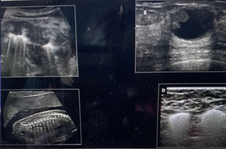 <p>Which image demonstrates posterior enhancement? Use your mouse to position the cursor over the image and click to set your answer.</p><p>a. top left <br>b. top right<br>c. bottom left <br>d. bottom right</p>