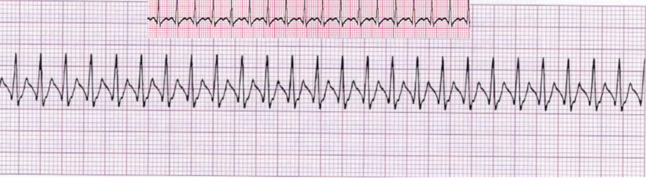 <ul><li><p class="Paragraph SCXW28767485 BCX0" style="text-align: left;"><span style="line-height: 24.4125px;">Phrase used to describe a rapid, regular supraventricular arrhythmia when more accurate identification is impossible because P waves aren’t visible and rate is common to other arrhythmias&nbsp;</span></p></li></ul><ul><li><p class="Paragraph SCXW28767485 BCX0" style="text-align: left;"><span style="line-height: 24.4125px;">SVTs with Overlapping Rate Ranges:&nbsp;</span></p><ul><li><p class="Paragraph SCXW28767485 BCX0" style="text-align: left;"><span style="line-height: 24.4125px;">Sinus Tachycardia 100-160 beats/min&nbsp;</span></p></li><li><p class="Paragraph SCXW28767485 BCX0" style="text-align: left;"><span style="line-height: 24.4125px;">Atrial Tachycardia 150-250 beats/min&nbsp;</span></p></li><li><p class="Paragraph SCXW28767485 BCX0" style="text-align: left;"><span style="line-height: 24.4125px;">Atrial Flutter 150-250 beats/min&nbsp;</span></p></li><li><p class="Paragraph SCXW28767485 BCX0" style="text-align: left;"><span style="line-height: 24.4125px;">Junctional Tachycardia 100-180 beats/min&nbsp;</span></p></li></ul></li></ul><ul><li><p class="Paragraph SCXW28767485 BCX0" style="text-align: left;"><span style="line-height: 24.4125px;">Fast, Regular, narrow QRS, no p wave, Upright&nbsp;</span></p></li></ul><ul><li><p class="Paragraph SCXW28767485 BCX0" style="text-align: left;"><span style="line-height: 24.4125px;">Make them vagal&nbsp;</span></p><ul><li><p class="Paragraph SCXW28767485 BCX0" style="text-align: left;"><span style="line-height: 24.4125px;">Bear down, ice water in face, lift legs up&nbsp;</span></p></li></ul></li></ul><p></p>