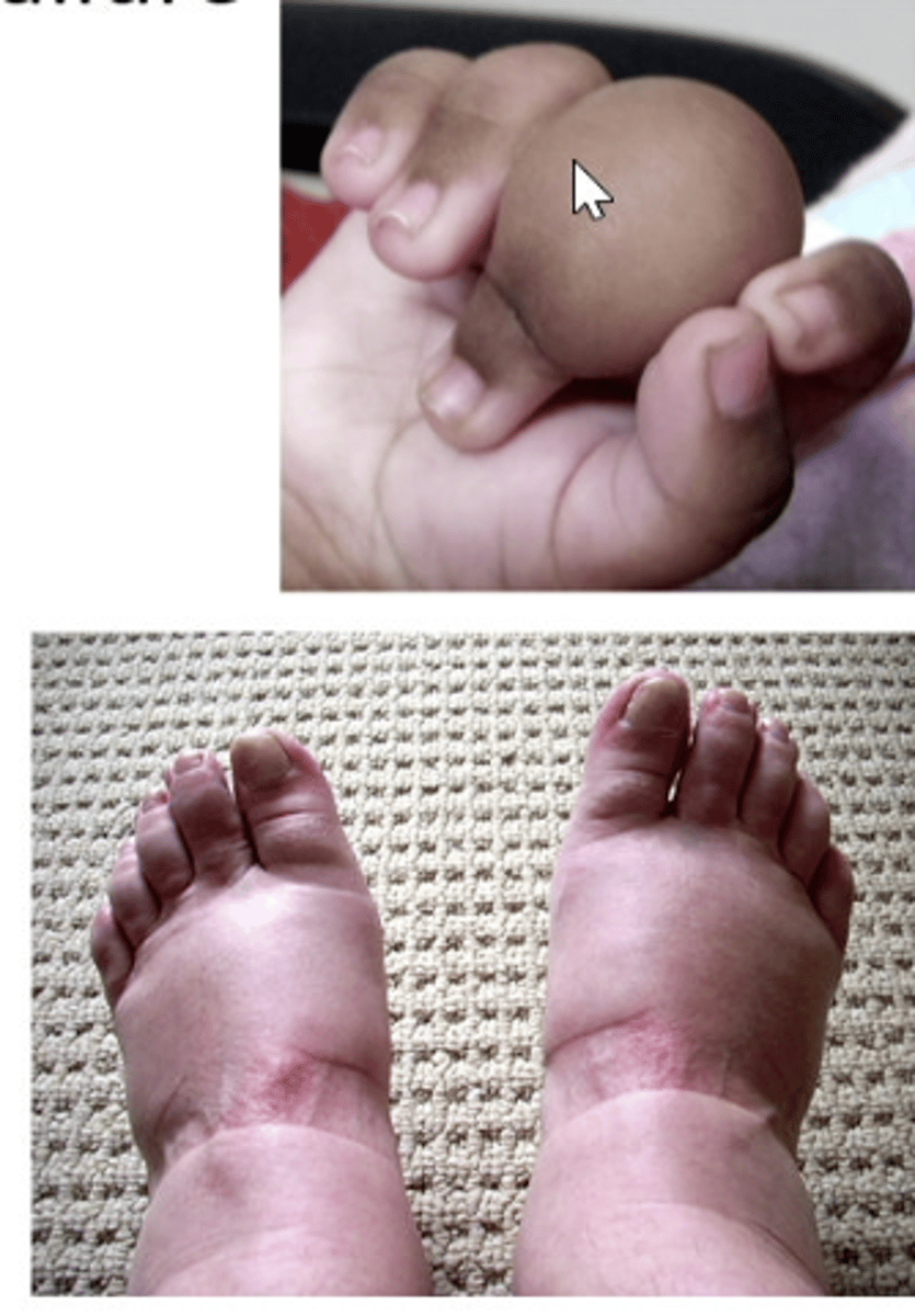 <p>localized edema - allergic or inflammatory conditions resulting from the release of histamine or other inflammatory mediators</p><p>generalized edema - result of increased vascular volume, caused by venous obstruction, excessive salt intake or water retention due to congestive heart failure/renal failure</p><p>potential causes:</p><p>increased vascular volume</p><p>1. heart failure</p><p>2. kidney disease</p><p>3. premenstrual sodium retention</p><p>4. pregnancy</p><p>venous obstruction:</p><p>5. liver disease with portal vein obstruction</p><p>6. acute pulmonary edema</p><p>7. venous thrombosis</p>