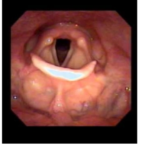 <p>In continuïteit met orofarynx. Grens = niveau tip epiglottis.<br>Subsites:<br>Hypofarynxachterwand<br>Sinus piriformis<br>Retrocricoidale regio</p>