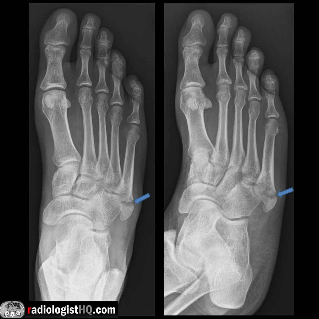 <p>What fracture is this? </p>