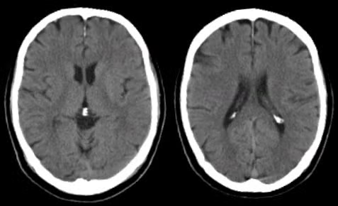 <p>a radiographic x-ray technique for quickly producing detailed, three-dimensional images of the brain or other soft tissues. <strong>shows structure</strong></p>