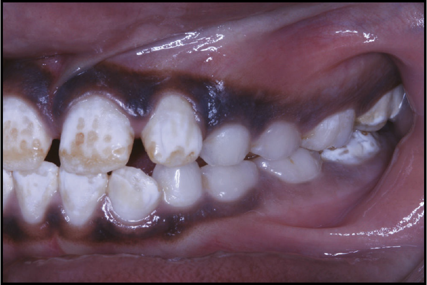 <p>what are causes of dental enamel hypoplasia </p>
