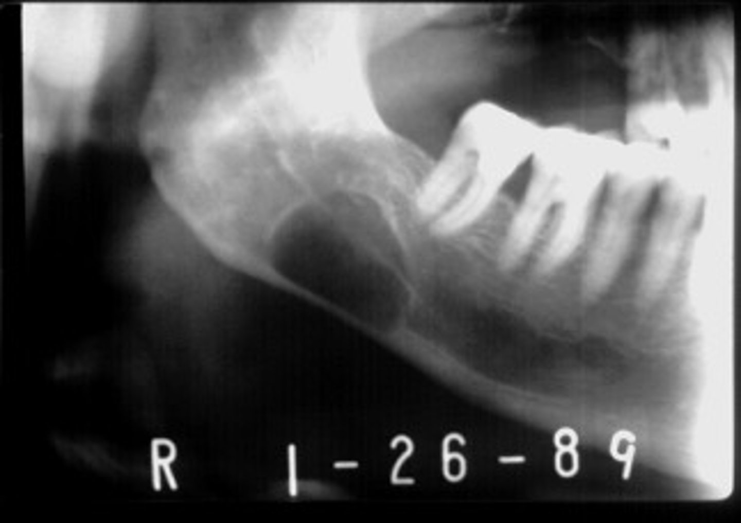 <p>•located between inferior alveolar nerve canal and inferior border of mandible</p><p>•oval/round/elliptical shape</p><p>•well-circumscribed radiolucency</p><p>•Dense sclerotic corticated (radiopaque border) usually on the superior aspect</p>
