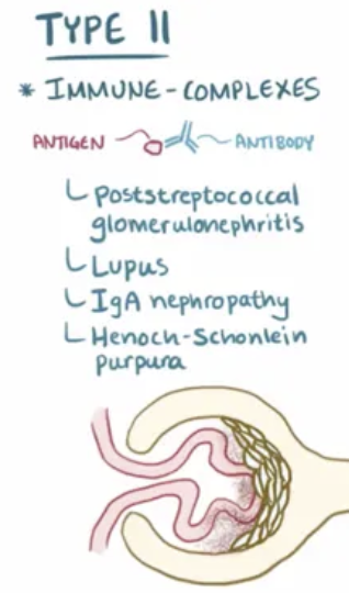 <p>Al tipo 2, por complejos inmunes</p>