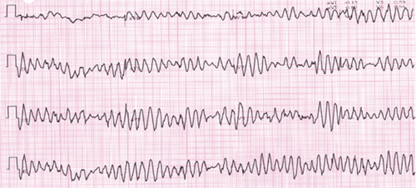 <p>Torsades de Pointes (TdP)</p>