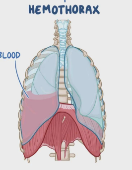 <p>What is hemothorax?</p>