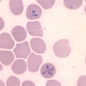 Refer to the picture below. This is seen during cases of what disease?

A. Malaria

B. Cystoisosporiosis

C. Babesiosis

D. Cryptococcosis

E. Cryptosporidiosis