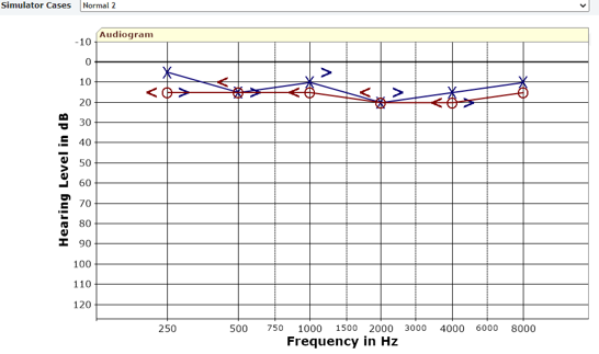 <p>What does this audiogram show ? </p><p></p>