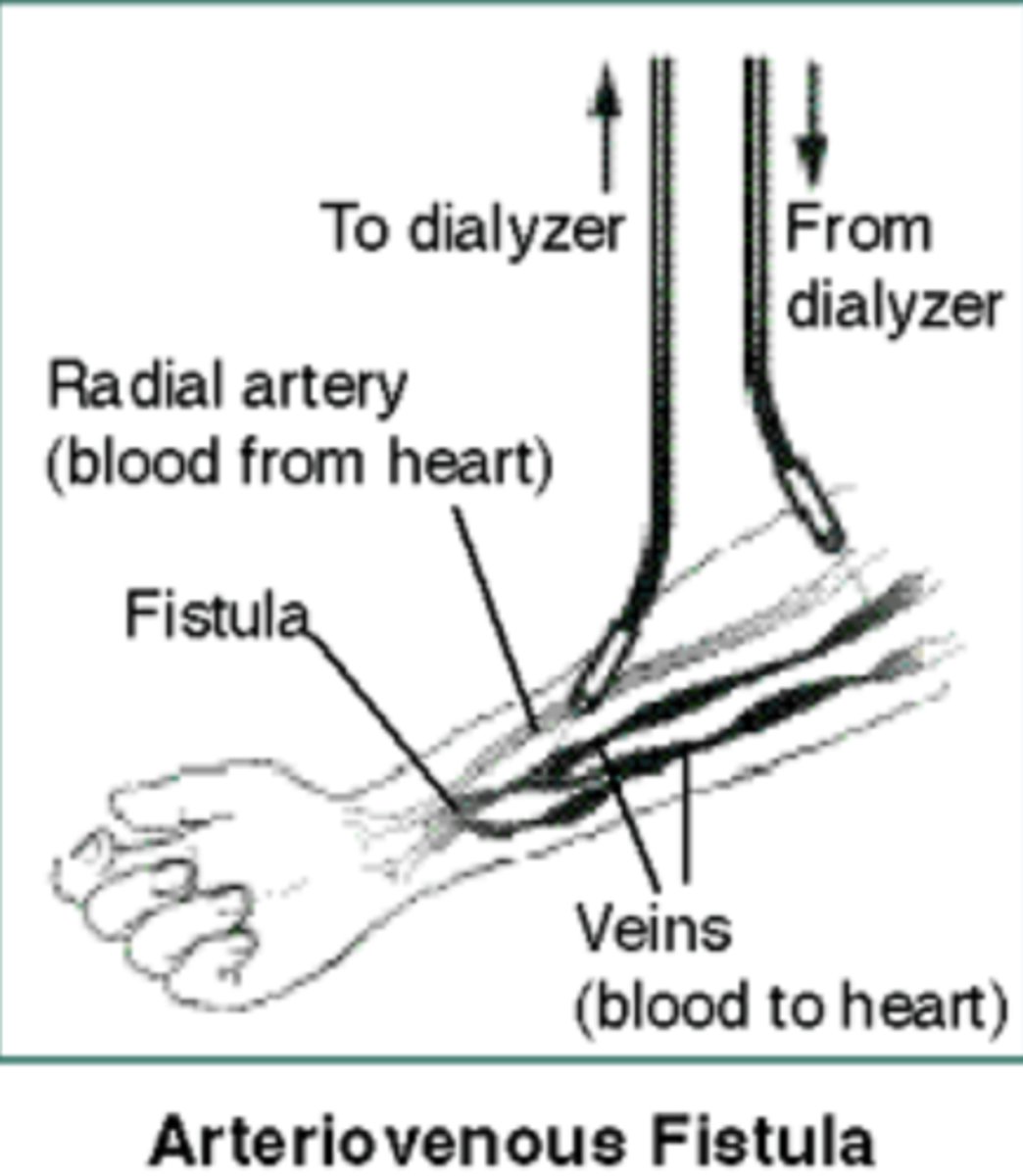 <p>Drop in peripheral resistance</p><p>Can handle 6 cycles a month</p><p>Audible swishing bruit</p><p>Palpable thrill/vibration - turbulent flow at anastomosis</p><p>Large enough for two 15-gauge needles</p>