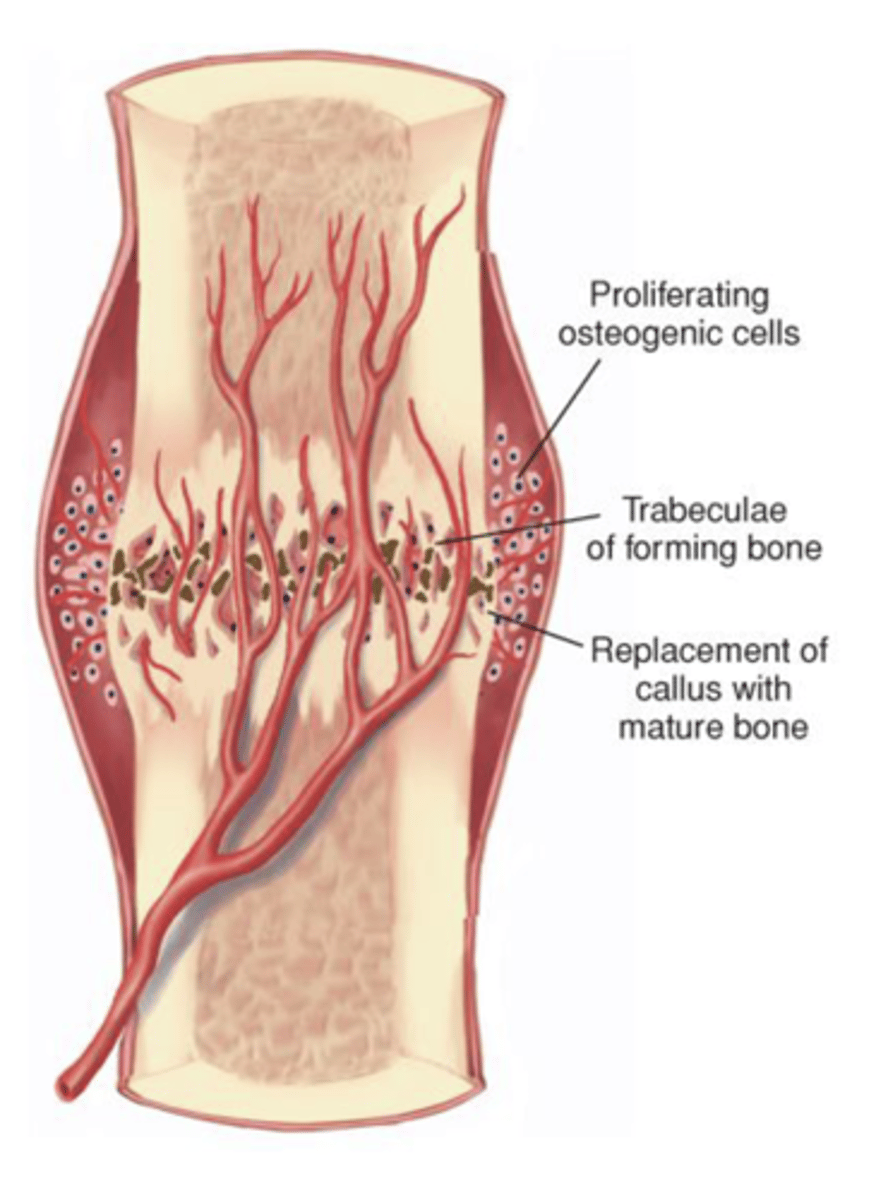 <p>Cartilage is ossified to form a bony callus</p><p>Formation of bone progresses toward the fracture site until a new bony sheath covers the callus</p><p>Fibrocartilage is converted to woven bone and gradually calcifies into mature bone</p><p>Begins 3 to 4 weeks after injury and continues for months later</p>