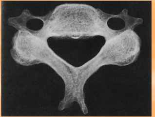 <p>Peculiar shapes (vertebrae, facial</p><p>bones, and pelvic bones) </p>