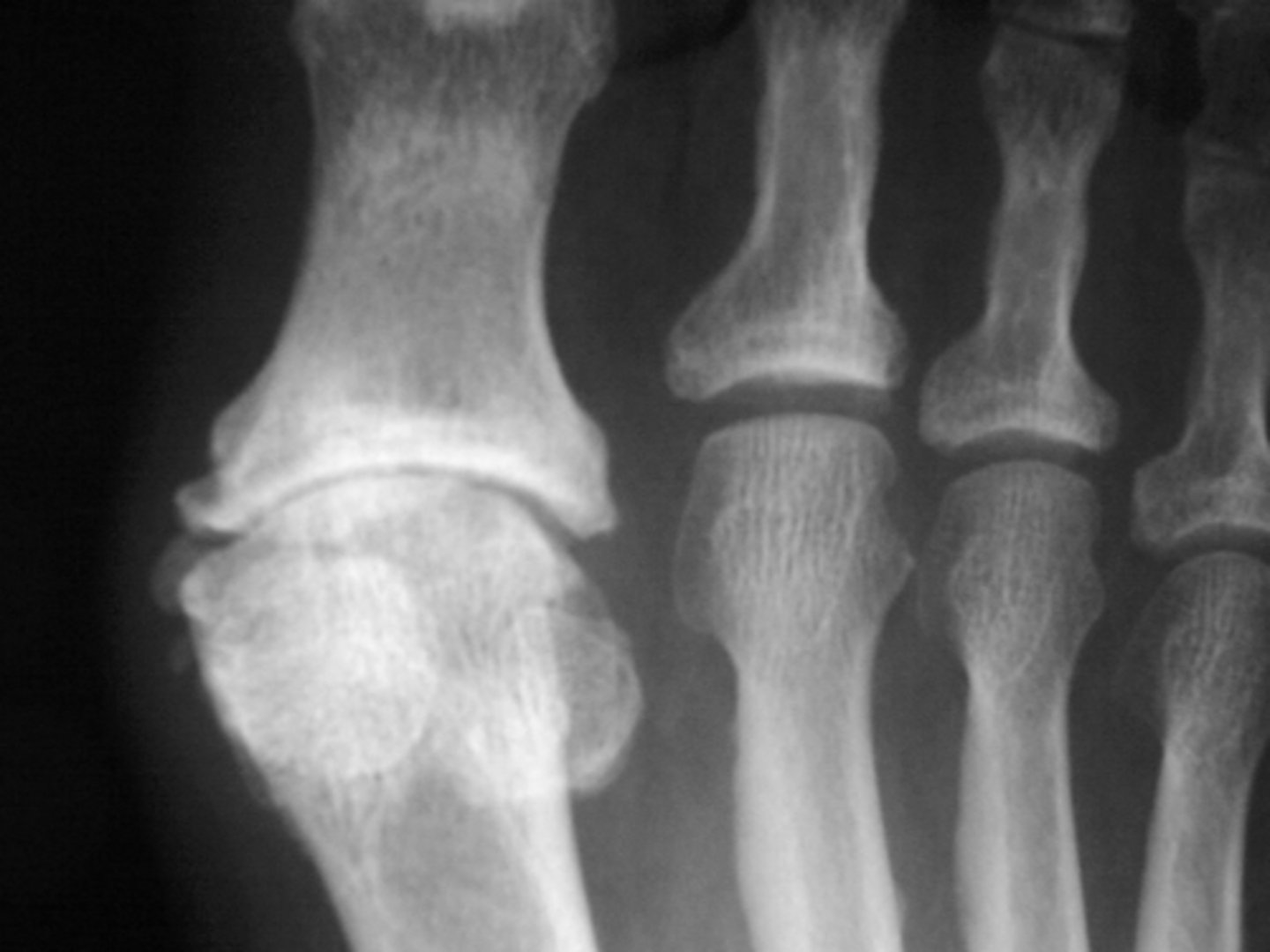 <p>State the clinical features of osteoarthrosis of the foot</p>