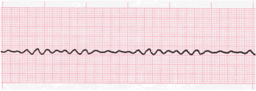 <p>What is the reading of this ECG?</p>