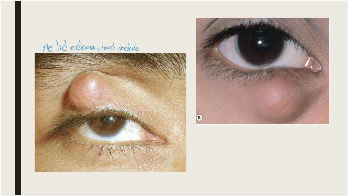 <p>A granulomatous inflammatory lesion of the meibomian gland </p>