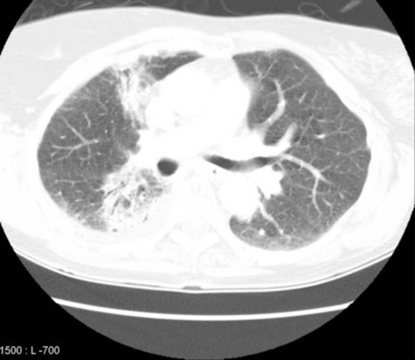 <p>A 62-year-old woman presents with progressive shortness of breath and a persistent dry cough over the past several months. She denies fever, sputum production, or chest pain. She notes that her symptoms have been slowly worsening and are now affecting her ability to climb stairs.</p><p>Her history is significant for left-sided breast cancer treated with radiation therapy, completed 10 months ago. She did well immediately after treatment with no acute complications.</p>