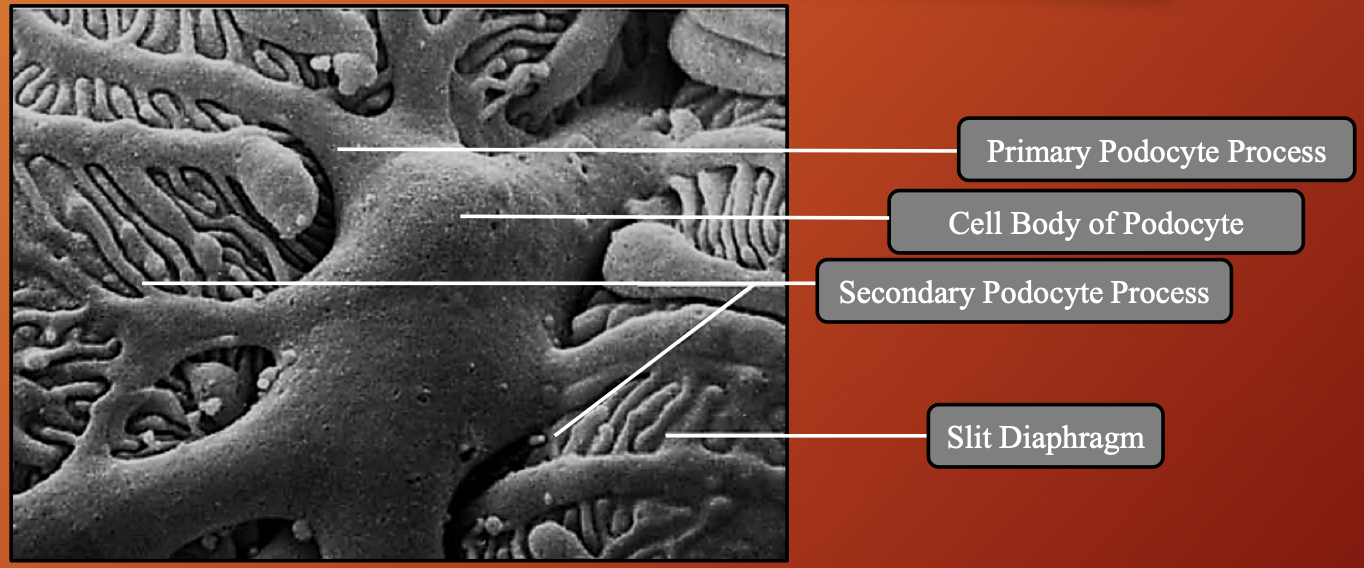 <p><strong><u>What:</u> </strong><span style="color: #ff7f00"><strong>Inner layer</strong></span><strong> </strong>that sits directly on<span style="color: #ff7f00"> <strong>glomerular capillaries </strong></span></p><p><strong><u>Made up of:</u> </strong><span style="color: #ff7f00"><strong>Podocytes</strong></span><strong> </strong>(<em>speacilased flattened cells that wrap around outside glomerular capillaries</em>) </p><ul><li><p><strong><u>How does it allow for filtration:</u> </strong><span style="color: #ff7f00"><strong>Don’t touch each </strong></span>other <span style="color: #ff7f00"><strong>completely</strong></span><strong> </strong></p></li></ul><p><strong><u>Which part bulges into Bowman’s space:</u> </strong><span style="color: #ff7f00"><strong>Nuclei</strong></span><strong> </strong>and <span style="color: #ff7f00"><strong>cell bodies </strong></span></p><p><span style="color: #ff7f00"><strong><mark data-color="yellow" style="background-color: yellow; color: inherit"><u>Primary process:</u> </mark></strong></span></p><ul><li><p><strong><u>What:</u> </strong><span style="color: #ff7f00"><strong>Long arm like extensions</strong></span><strong> </strong>from <span style="color: #ff7f00"><strong>podocyte cell body </strong></span></p></li><li><p><strong><u>Rich in:</u> </strong><span style="color: #ff7f00"><strong>Actin</strong></span></p></li><li><p><strong><u>Function:</u> </strong>Help with <span style="color: #ff7f00"><strong>shape</strong></span><strong> </strong>and <span style="color: #ff7f00"><strong>support</strong></span><strong> </strong></p></li></ul><p><span style="color: #ff7f00"><strong><mark data-color="yellow" style="background-color: yellow; color: inherit"><u>Secondary process:</u></mark></strong></span></p><ul><li><p><strong><u>What:</u> </strong><span style="color: #ff7f00"><strong>Branches</strong></span><strong> </strong>that come off <span style="color: #ff7f00"><strong>primary processes </strong></span></p></li><li><p><strong><u>Function:</u></strong><span style="color: #ff7f00"><strong> Increase SA </strong></span></p></li></ul><p><span style="color: #ff7f00"><strong><mark data-color="yellow" style="background-color: yellow; color: inherit"><u>Tertiary process:</u> </mark></strong></span></p><ul><li><p><strong><u>What:</u> </strong><span style="color: #ff7f00"><strong>Final, tiny extensions</strong></span><strong> </strong>that in <span style="color: #ff7f00"><strong>direct contact </strong></span>with <span style="color: #ff7f00"><strong>basement membrane</strong></span></p></li></ul><p><strong><u>What is slit diaphragm:</u> </strong><span style="color: #ff7f00"><strong>Interdigital space</strong></span><strong> </strong>between <span style="color: #ff7f00"><strong>tertiary process</strong></span></p><ul><li><p><strong><u>Function:</u> </strong>Acts like <span style="color: #ff7f00"><strong>tiny filtration barrier </strong></span></p></li></ul><p></p>