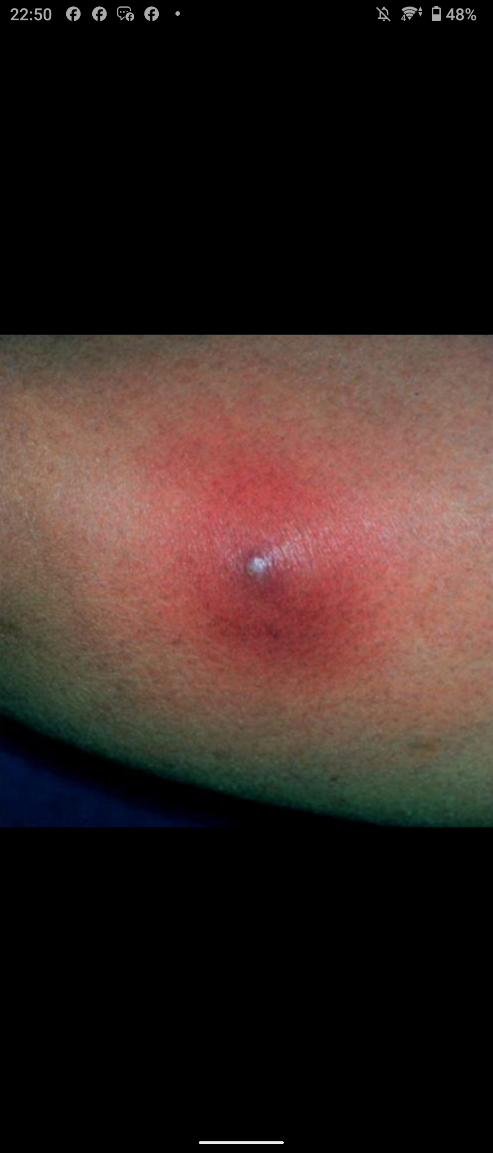 <p>34 Infected</p>