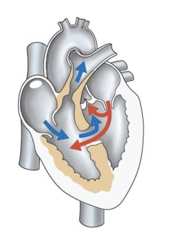 <p>what kind of congenital heart defect is this?</p>