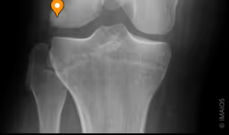 <p>Vad är markerat lateralt i vilka muskler?</p>