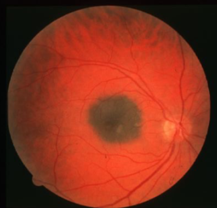 <p>what is the concern for this being melanoma? </p>