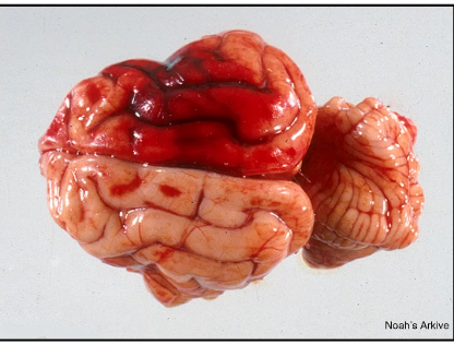 <p>what type of hemorrhage is this?</p>