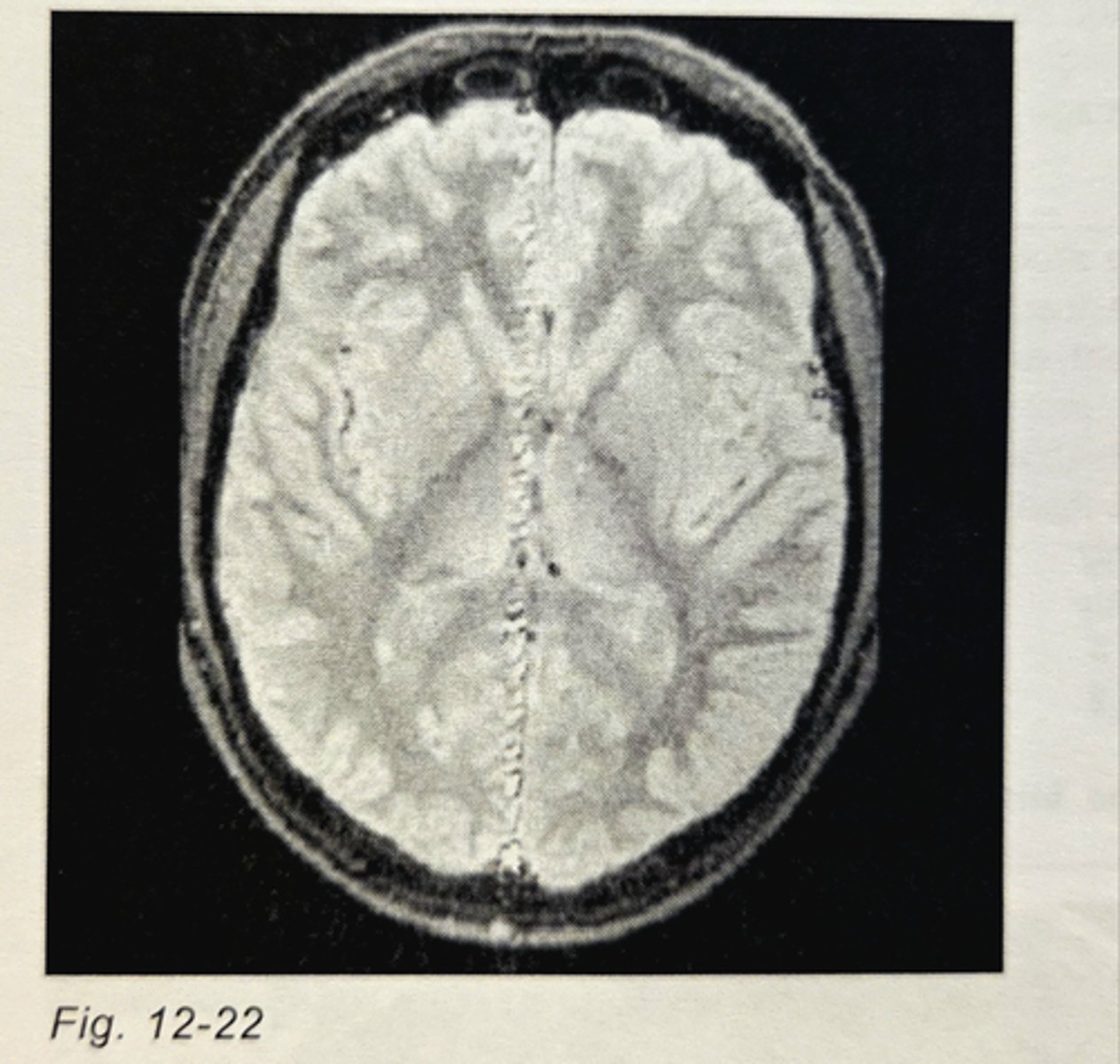 <p>extend horizontally across the posterior aspect of the brain</p><p>3 multiple choice options</p>