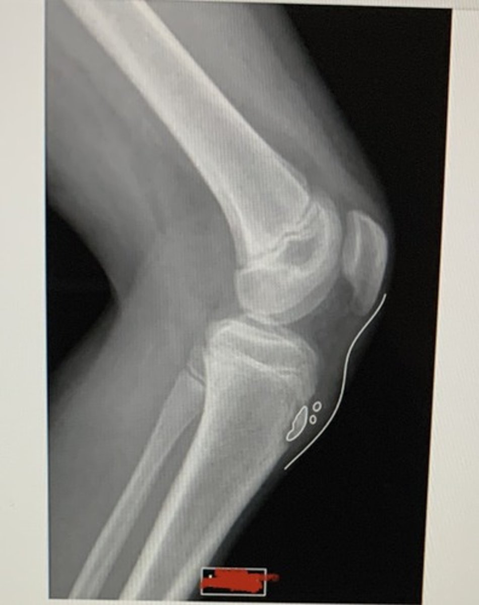 <p>- enlarged tibial tubercle<br>- repetitive trauma at distal tendon attachment<br>- common in adolescent boys<br>- USE LATERAL RADIOGRAPH</p>