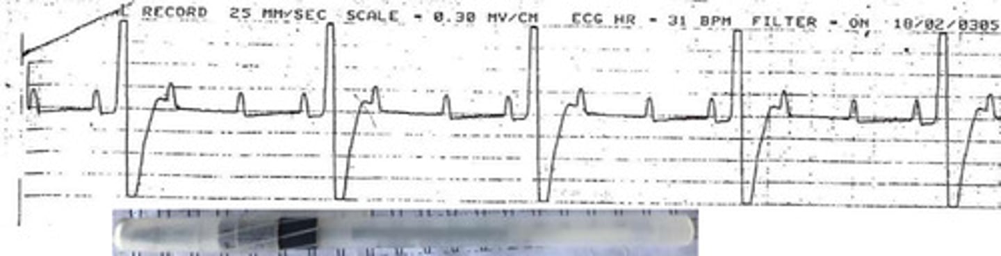 <p>What is this arrhythmia?</p>
